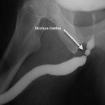 Üretra Darlığı Hayati Tehlike Oluşturur mu?