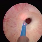 Üretra Darlığında Lazer Tedavisi Var mı?
