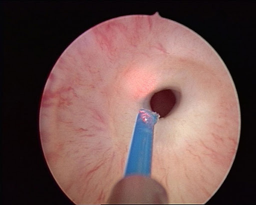 Üretra Darlığında Lazer Tedavisi Var mı?